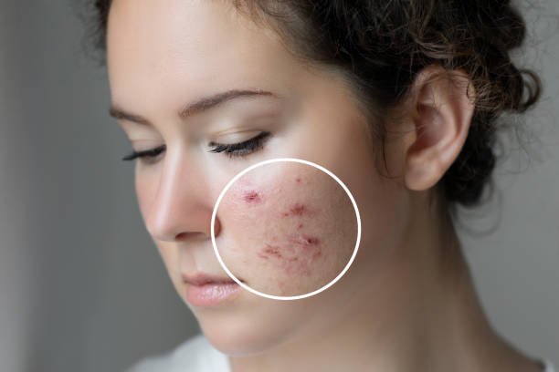 Advanced Pimples Treatment for Long Lasting Results